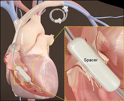 Treatment of Tricuspid Regurgitation With the FORMA Repair System